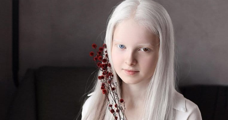 Are 11 ani, suferă de albinism și este una dintre cele mai frumoase fetițe din lume!